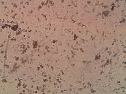 Amorphous Phosphate Crystals Of Urine Sediment Under Microscopy Sediment Microscopy Urinal