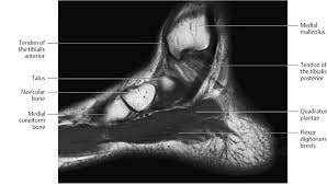 In addition, an image of all the muscles of the back and plantar part of the foot, all tendons and tendon ligaments, blood vessels and nerves are obtained. Ankle And Foot Radiology Key