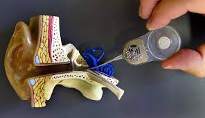 Image result for Cochlear Implant