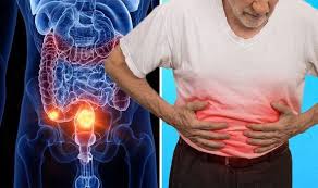 When colon cancer is detected in its early stages, it may not have even caused symptoms. Bowel Cancer Symptoms Pain In The Abdomen Could Be Indicative Of The Disease Express Co Uk