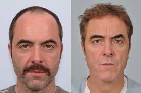 James nesbitt in cold feet, 1996. James Nesbitt Hair Transplant At Hrbr Latest Results
