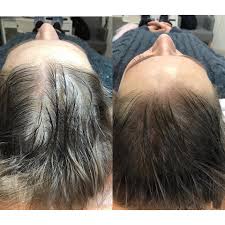 Fondamentalmente la micropigmentazione è definita come un tipo di tatuaggio che include la tecnica del microblading. Beauty Matrioska Tricopigmentazione Capelli Donna La Tricopigmentazione E Una Micropigmentazione Del Cuoio Capelluto Che Imita I Follicoli Piliferi In Modo Di Qualita Con L Aiuto Di Questa Procedura Vengono Risolti I Problemi