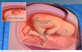 Spina Bifida Care At Mayo Clinic Mayo Clinic