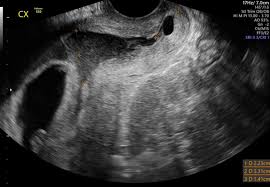 Image result for First Trimester Ultrasound