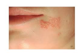 Image result for red rash face
