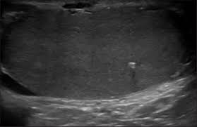 It's fairly rare and very treatable. Burned Out Testicular Tumor In 24 Year Old Man Ultrasound Image Of Download Scientific Diagram