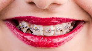 Dente Encavalado Quanto Custa O Tratamento E Quais As Causas