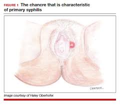 Image result for Primary Syphilis