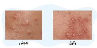 فرق زگیل مقعدی با جوش