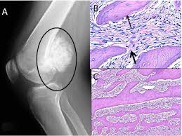 Calcifications occurring in a benign tumor or in a malignant tumor that is well differentiated may be the product of endochondral ossification. Differential Diagnosis Of Osteogenic Tumors In The Context Of Osteosarcoma Intechopen