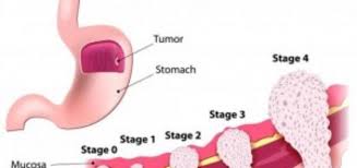 Symptoms of advanced stomach cancer are more serious than symptoms of early stage stomach cancer. Advanced Stomach Cancer Science Online
