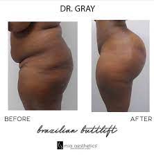 Mia aesthetics abdominal board was designed with wings to wrap around the waist for additional shaping of the abdomen. Mia Aesthetics Bbl By Dr Gray What A Change Facebook