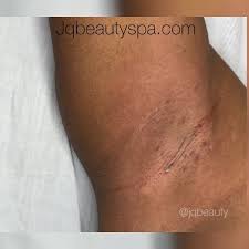 Developing underarm rash could be caused by contact dermatitis, and some of the triggers that are after shaving having ingrown hairs. Jq Beauty Spa Underarm Ingrown Hair Extraction
