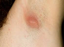 Ingrown armpit hair, bump, lump or cyst can be painful especially if it gets infected. Pin On Ingrown Hair