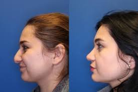 It is not a good idea to shop a nose job on price alone, as this puts you at risk for an unfavorable outcome. Nose Surgery Before After Photos Patient 260 San Francisco Ca Kaiser Permanente Cosmetic Services
