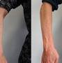 treatment for bulging hand veins from palmclinic.co.nz