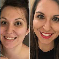 With this type of invisalign financing plan, patients can break up the total invisalign treatment cost into a series of monthly payments. The Invisalign Cost How Much Is Invisalign Treatment