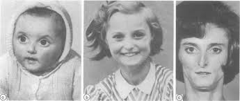 a, b, and c Baby, childhood, and adultfacies ofcase 13 showing typical...