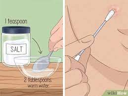 How To Get Rid Of A Zit Overnight (With Pictures) - Wikihow