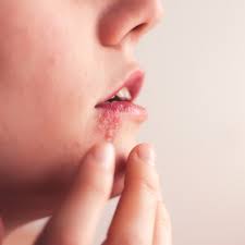 About Oral Herpes