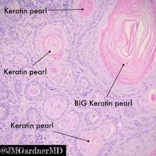 Keratin pearls, elongated cellular configurations (tadpole cells), and numerous anucleated squames may be present as well. Jerad Gardner Md On Twitter Keratin Pearls Trapped Keratin Within Cystic Nests Of Invasive Squamous Cell Carcinoma Unlike The Horn Pseudocysts Of A Seborrheic Keratosis Pearls Are 1 Dense Parakeratin Not Loose Flaky