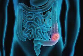 Image result for Intestinal Obstruction