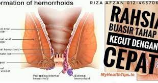 Buasir luar terletak dalam dubur dan sering tidak selesa. My Health Venture Bongkar Rahsia Pakcik Penghidap Buasir Tahap 3 Kecutkan Buasirnya Yang Terkeluar