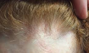 This causes the hair to break off at the scalp surface and the scalp to flake or become scaly. Do I Have Frontal Fibrosing Alopecia Donovan Hair Clinic Alopecia Hairstyles Hair Clinic Alopecia