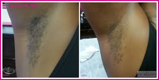 The number and growth direction of a person's hair follicles is genetically determined. Smoothness Me Beauty Detroit