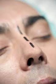 So what qualifies as a cosmetic reason? Thinking About Rhinoplasty Harvard Health