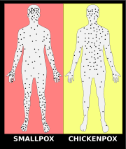 Jun 28, 2016 · smallpox is an ancient disease caused by the variola virus. å¤©èŠ± Wikiwand