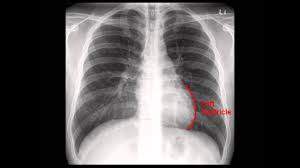 It would be wrong to base a diagnosis on only the most obvious features of any chest x ray. Chest X Rays Physiopedia