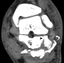 * converts the electrical signal that we get from detectors into a measure of attenuation and thickness (ct numbers). Multidetector Ct Evaluation Of Calcaneal Fractures Radiographics