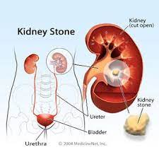 Ultrasound can reveal blockages in urine flow, stones, cysts, or suspicious masses. 7c6jyt8ddd63bm