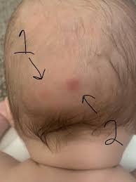 However, the back of your head can develop abnormal lumps or bumps that appear in various forms. Lumps On Babies Head With Pics Mumsnet