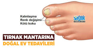 Onikomikoz Olarak Da Bilinen Tirnak Mantari Cok Yaygin Bir Sorun Bu Yazida Tirnak Mantari Tedavisi Icin Hazirlayabileceginiz Ev T Tirnak Batmasi Tirnak Mantar