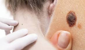 How can i tell if the new moles developing on my skin are cancerous? Skin Cancer Early Symptoms To Spot Include Moles Changing Or Pink Growths Toysmatrix