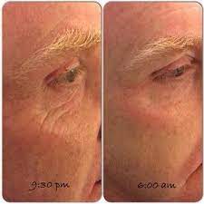 Introducing Acute Care Fill A Wrinkle While You Sleep No Needle Required New Skincare Technology That Rodan And Fields Redefine Rodan And Fields Acute Care