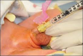 Image result for Neonatal Circumcision