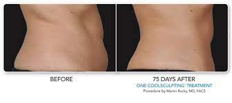 Coolsculpting before and after men. Coolsculpting Before And After Real Patient Photos Vein And Laser Institute