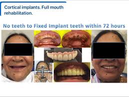 Cortical implants.Full mouth rehabilitation. No teeth to fixed implant…