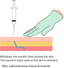7 4 Intramuscular Injections Clinical Procedures For Safer