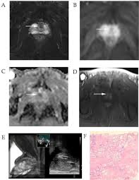 This trial focused on the accuracy of mri for staging prostate cancer in men with clinically localized disease and who had radical prostatectomy. The Diagnostic Value Of Pi Rads V1 And V2 Using Multiparametric Mri In Transition Zone Prostate Clinical Cancer