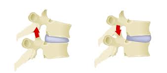 Treatment usually involves closed or open reduction followed by surgical stabilization. Facet Joint Syndrome Macomb Spine Care