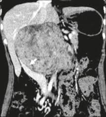 Check spelling or type a new query. Scielo Brasil Practical Approach To Primary Retroperitoneal Masses In Adults Practical Approach To Primary Retroperitoneal Masses In Adults