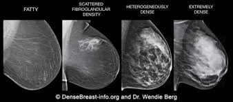 Image result for Mammogram Interpretation