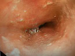 Thrush in the Food Pipe (Esophageal Candida) 
