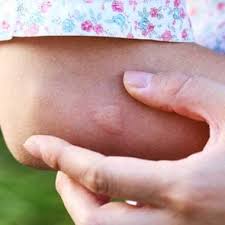 Image result for wolf spider bite skin