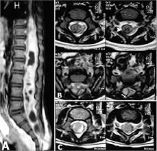 There is prominent myxoid stroma within the nodules. Spinal Intramedullary Hamartoma With Acute Presentation In A 13 Month Old Infant Case Report In Journal Of Neurosurgery Pediatrics Volume 18 Issue 2 2016