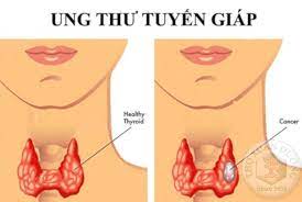 Bệnh ung thư tuyến giáp thường hình thành và phát triển âm thầm, dấu hiệu bệnh thường không rõ ràng, không gây đau đớn cho nên bệnh nhân thư. Ung ThÆ° Tuyáº¿n Giap Sá»'ng Ä'Æ°á»£c Bao Lau